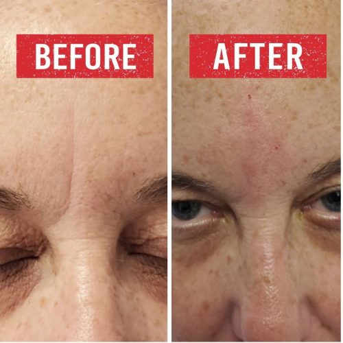 Wrinkle treatment before and after.