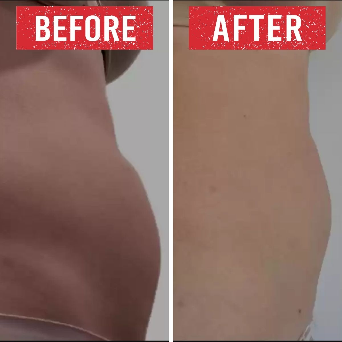 Body contouring treatment before and after.