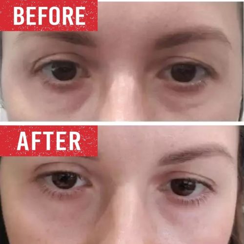 Under eyes treatment before and after.