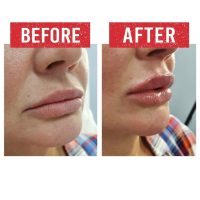 Lip Filler before and after.