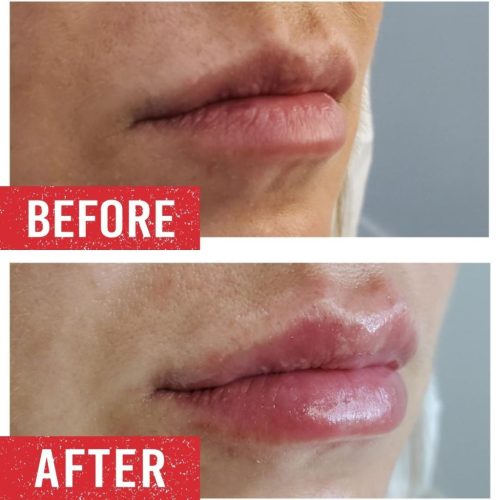 Lip Filler treatment before and after.