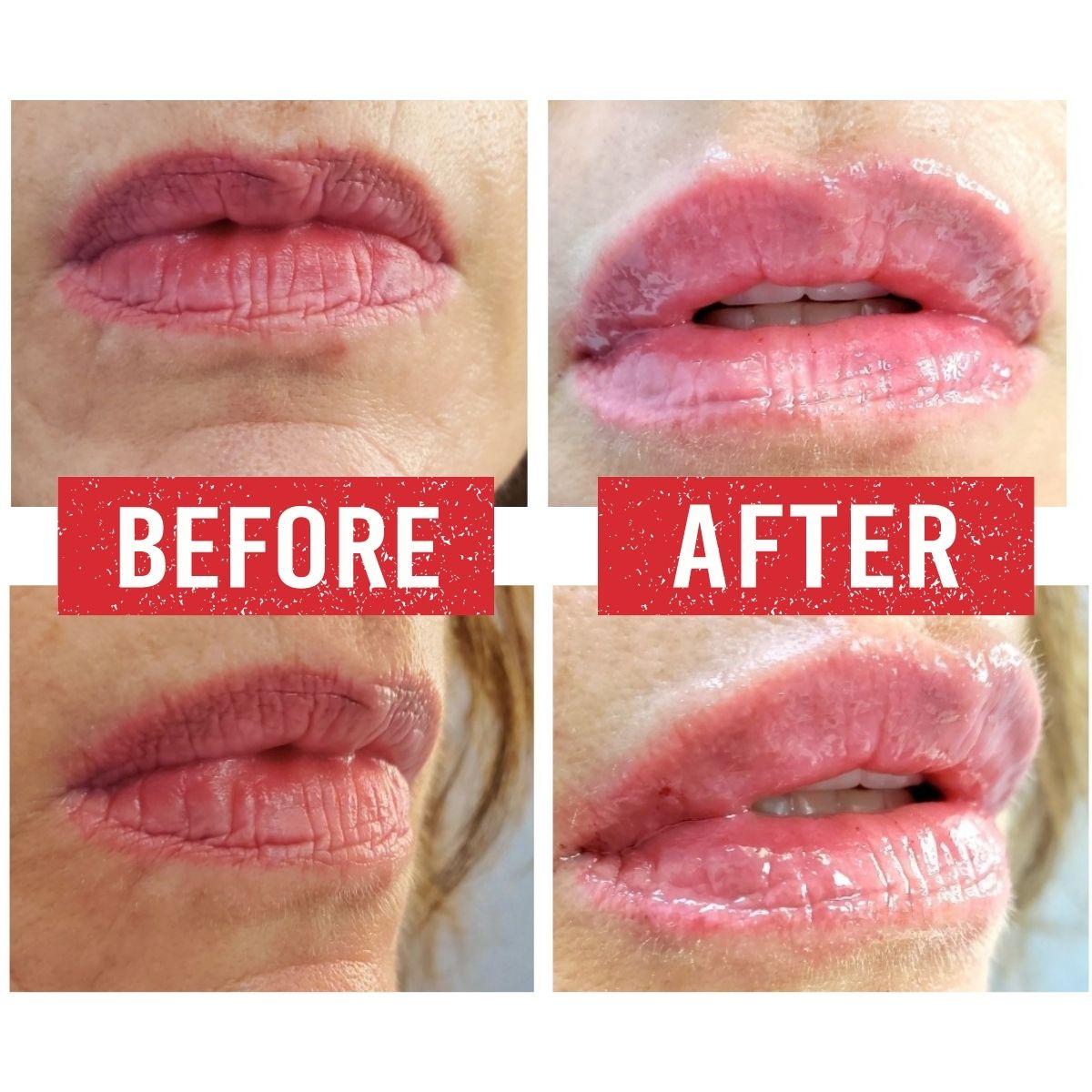 Lip Filler before and after.