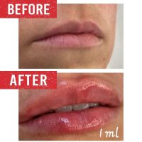 Lip Filler treatment before and after.