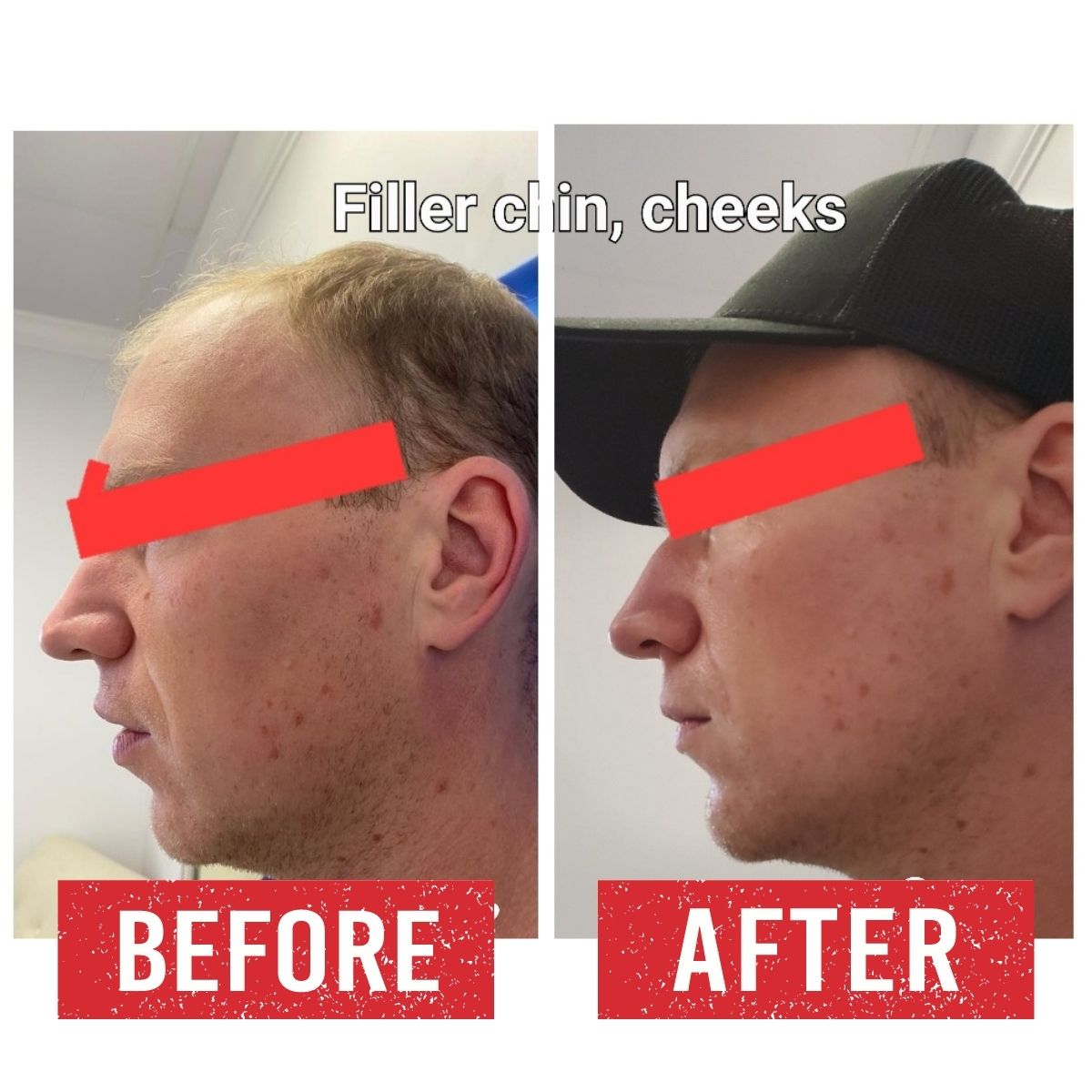 Filler treatment before and after.