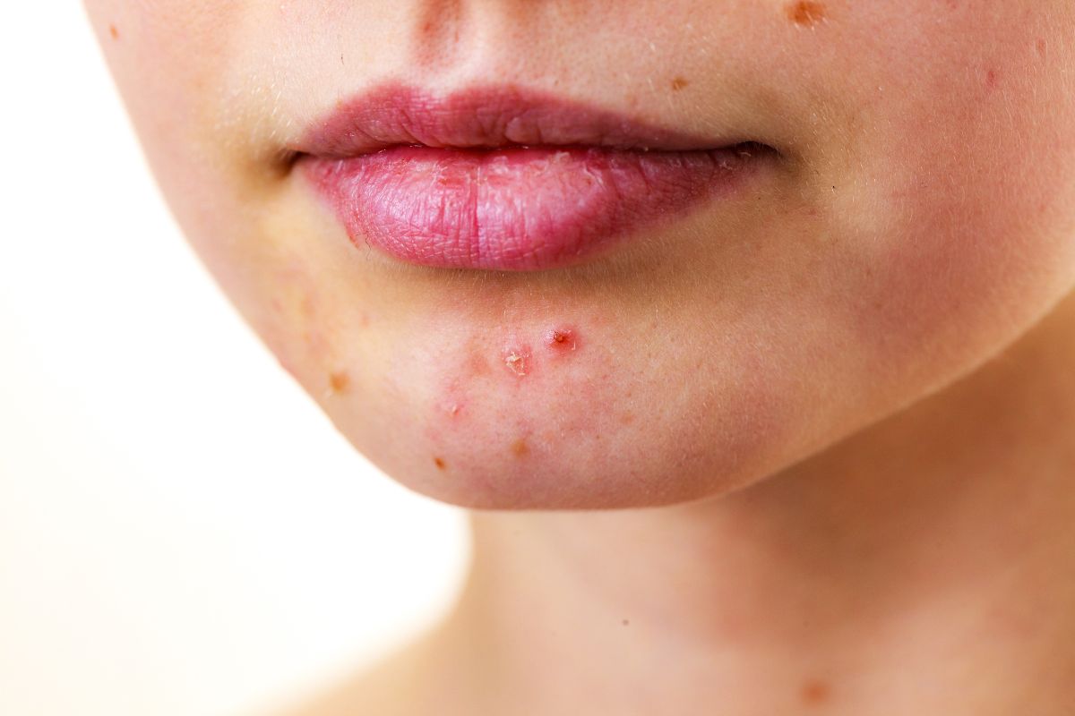 A woman has skin acne on her face.
