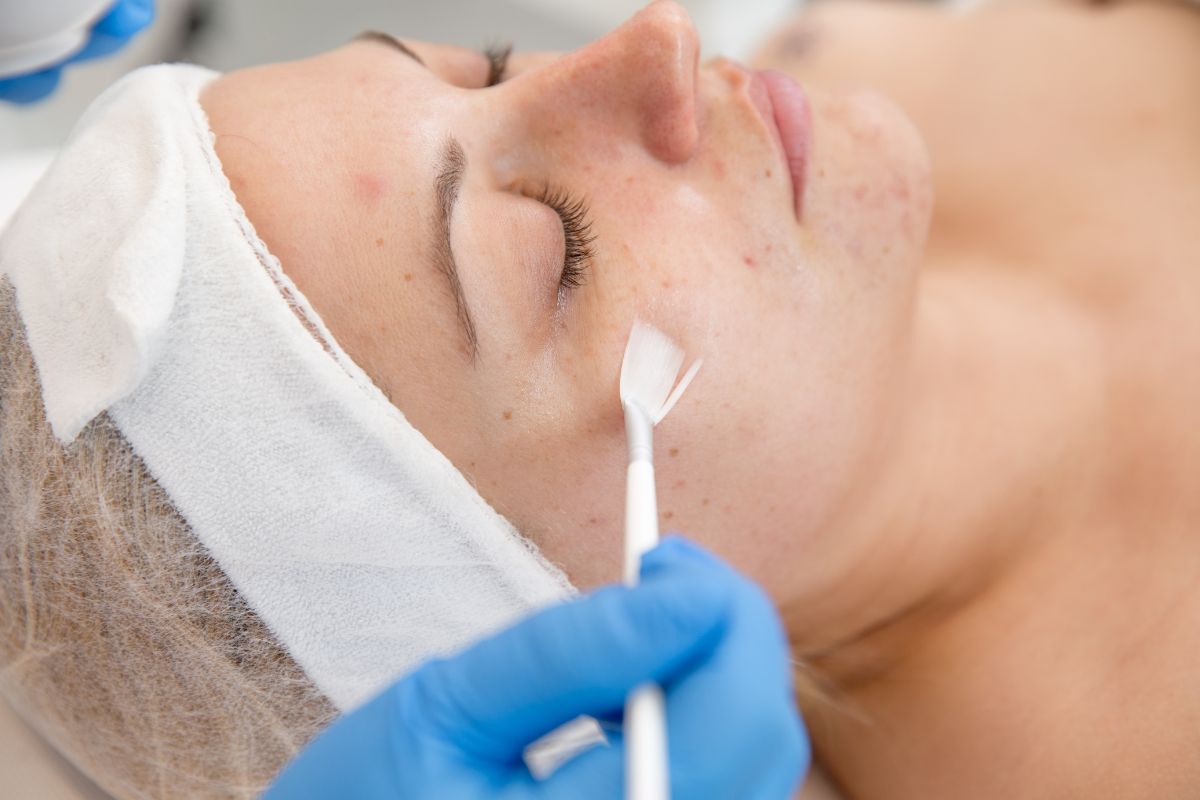 The woman chooses to get chemical peels for acne scars.